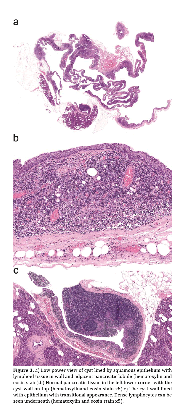pancreas-lined-squamous-epithelium
