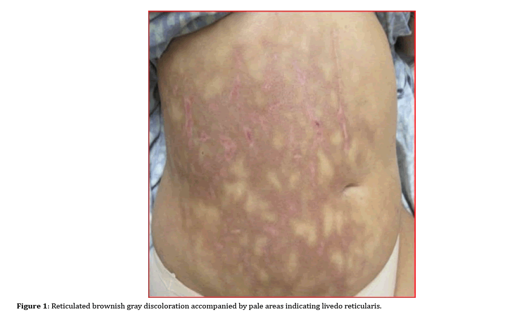 pancreas-livedo-reticularis