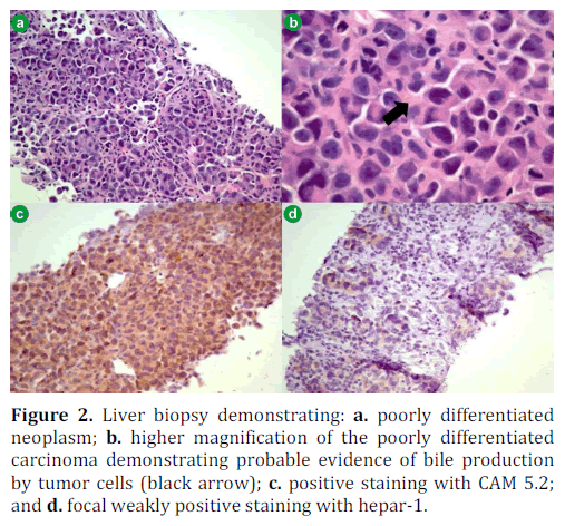 pancreas-liver-biopsy-neoplasm