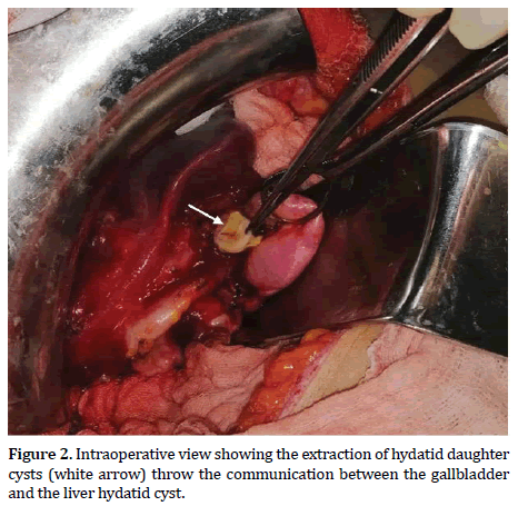 pancreas-liver-hydatid-cyst