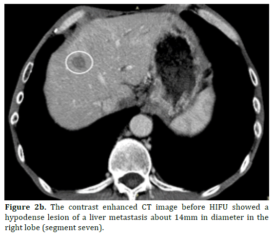 pancreas-liver-metastasis