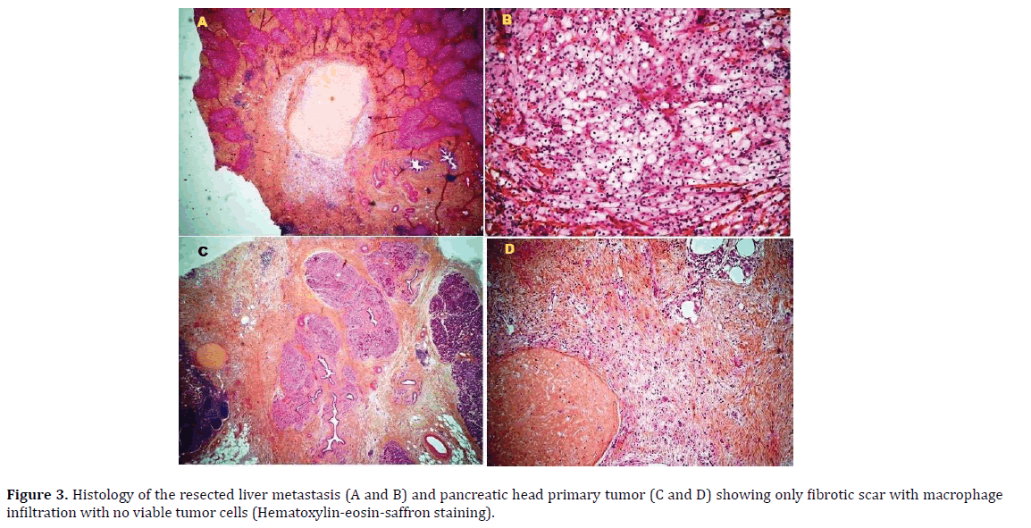 pancreas-liver-metastasis