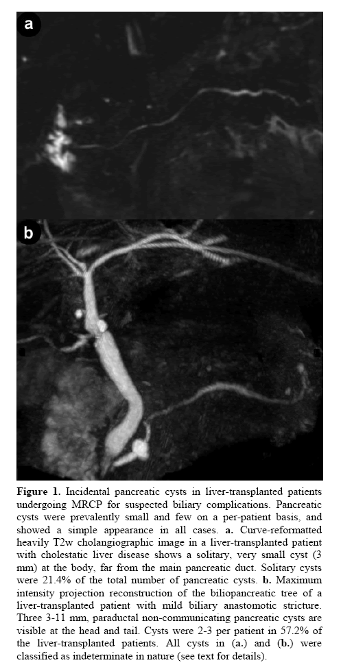 pancreas-liver-transplanted