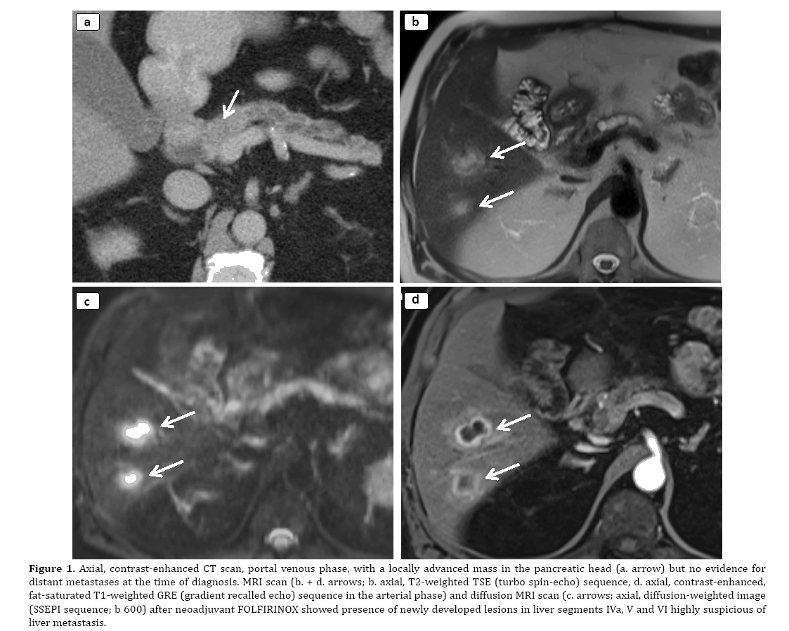 pancreas-locally-advanced-mass