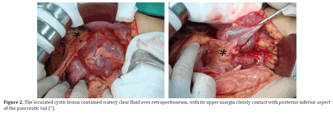 pancreas-loculated-cystic-lesion