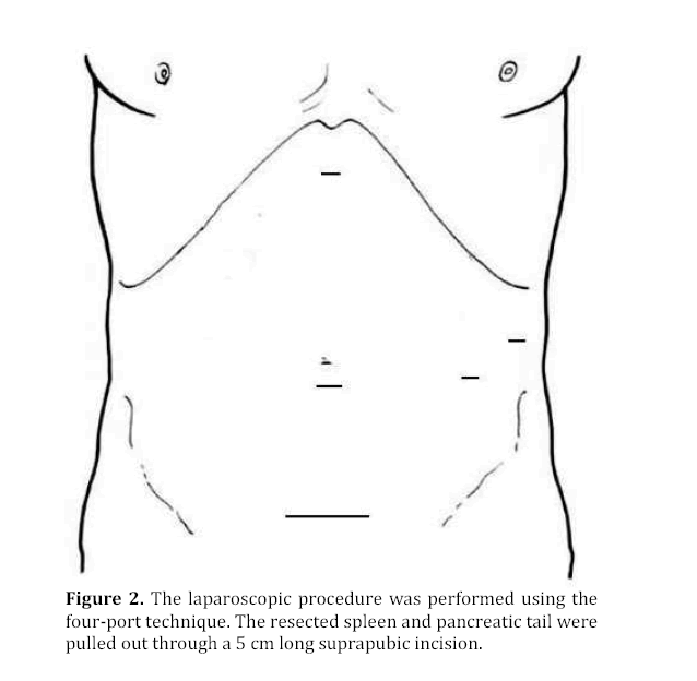 pancreas-long-suprapubic-incision