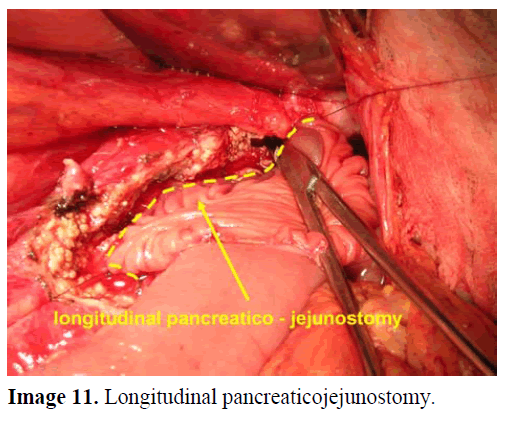 pancreas-longitudinal-pancreaticojejunostomy