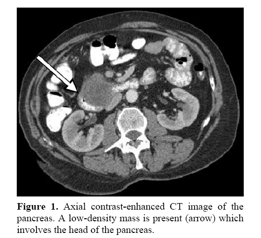 pancreas-low-density-mass