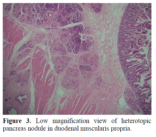 pancreas-low-magnification-heterotopic