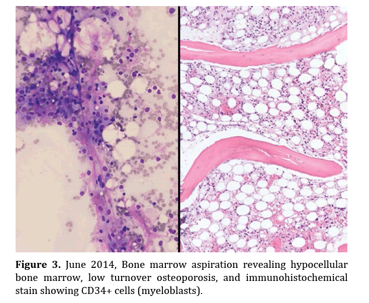 pancreas-low-turnover-osteoporosis