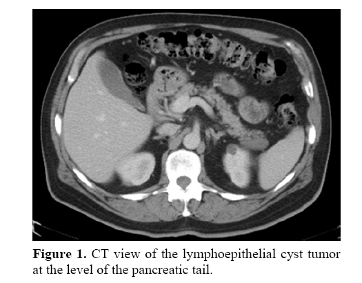 pancreas-lymphoepithelial-cyst-tumor