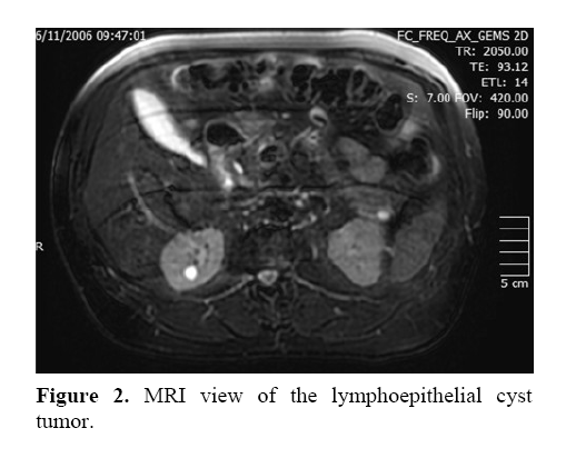 pancreas-lymphoepithelial-cyst-tumor