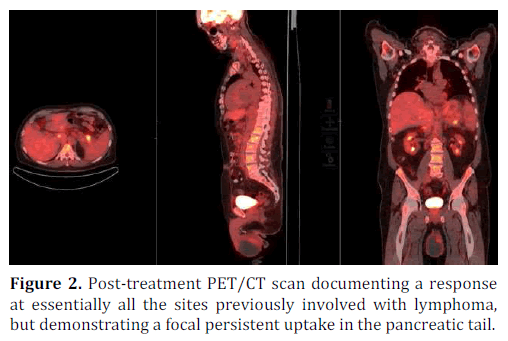 pancreas-lymphoma-focal-persistent