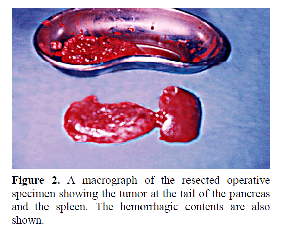 pancreas-macrograph-resected-operative