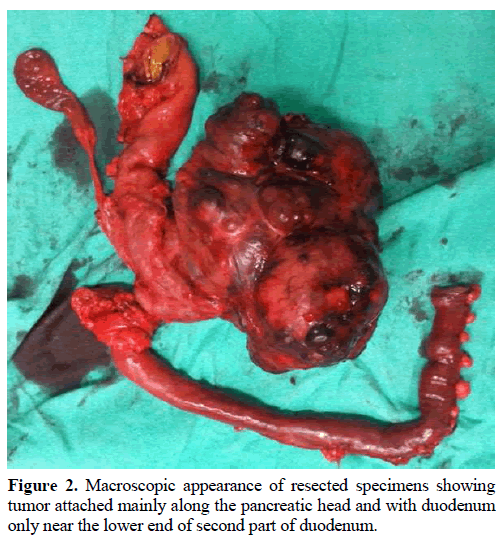 pancreas-macroscopic-appearance-resected