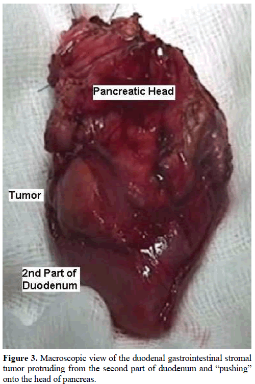 pancreas-macroscopic-view-duodenal