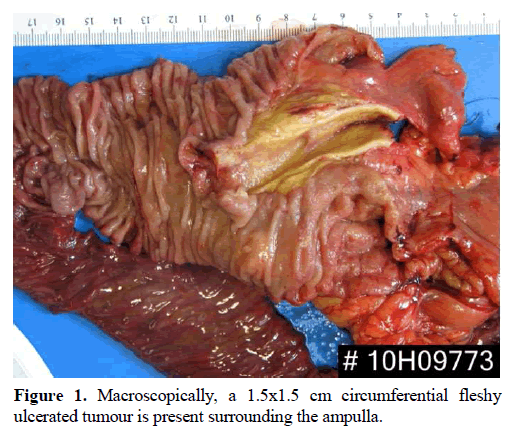 pancreas-macroscopically-ulcerated-tumour