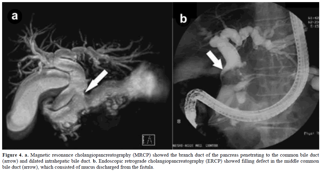 pancreas-magnetic-cholangiopancreatography