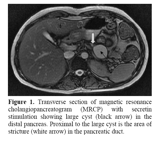 pancreas-magnetic-resonance-cholangiopancreatogram