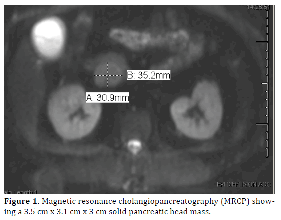 pancreas-magnetic-resonance-cholangiopancreatography