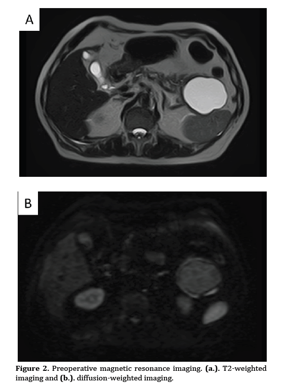 pancreas-magnetic-resonance-imaging