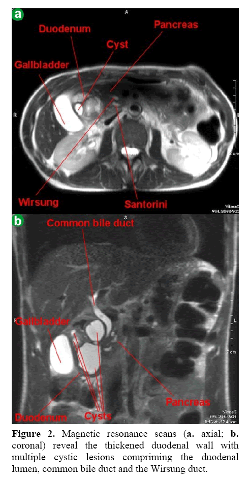 pancreas-magnetic-resonance-scans