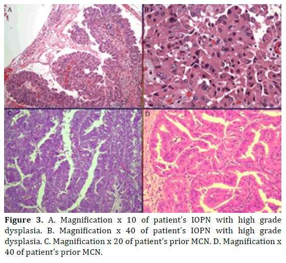 pancreas-magnification-dysplasia