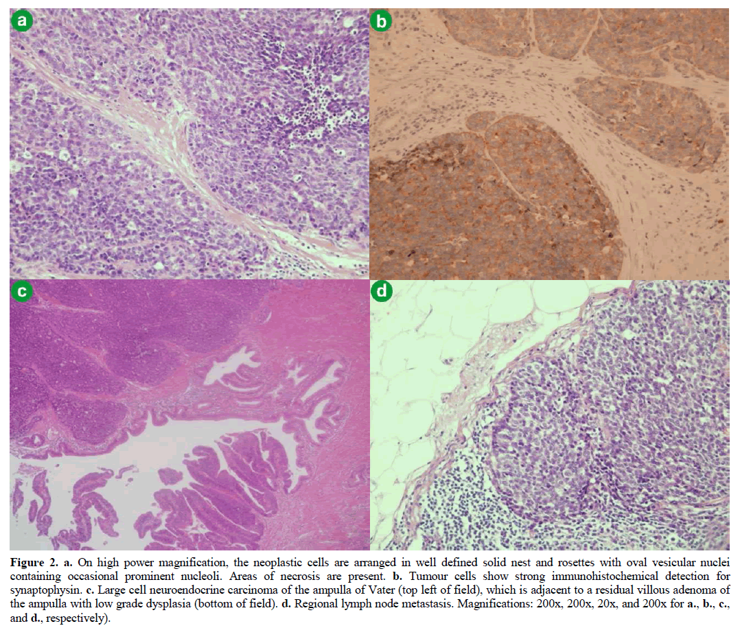 pancreas-magnification-neoplastic-cells