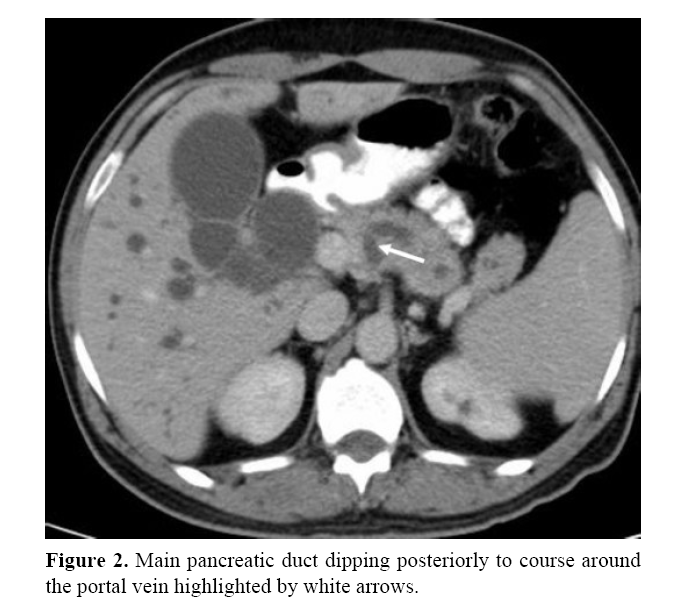 pancreas-main-pancreatic-duct