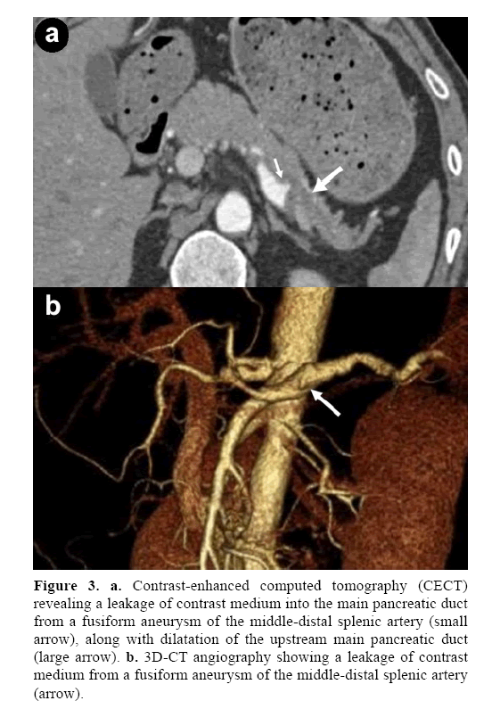 pancreas-main-pancreatic-duct