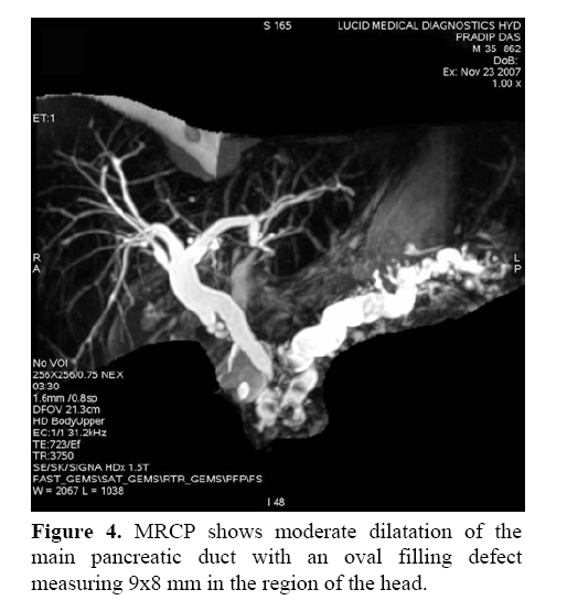 pancreas-main-pancreatic-duct