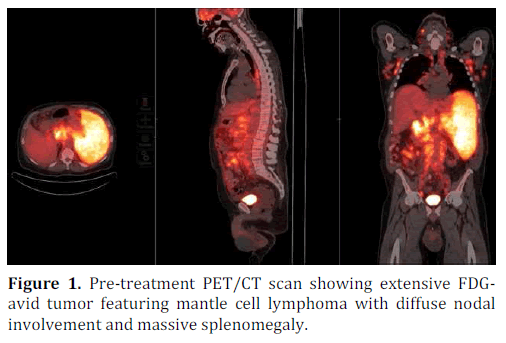 pancreas-mantle-cell-lymphoma