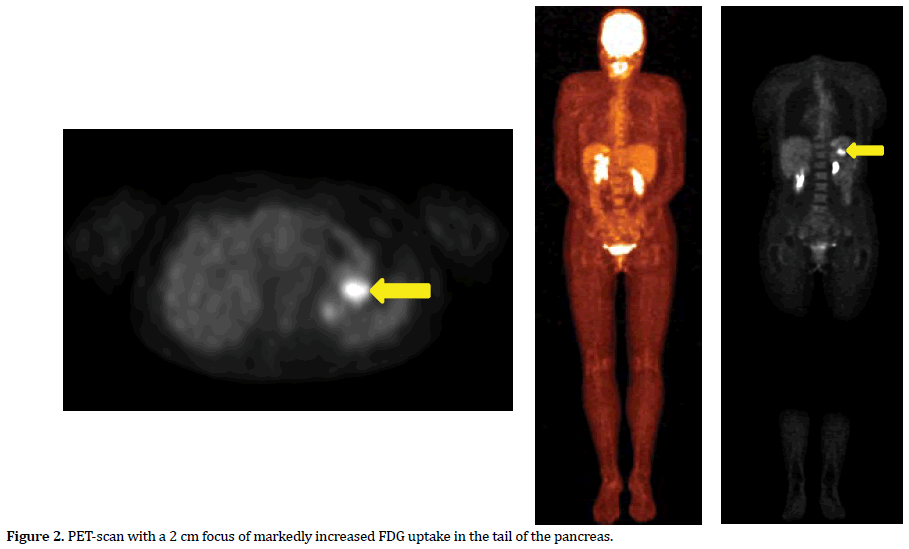 pancreas-markedly-increased