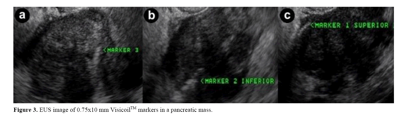 pancreas-markers-pancreatic-mass