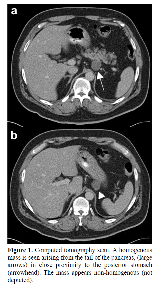 pancreas-mass-appears-non-homogenous