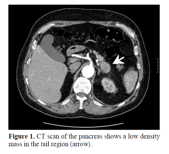 pancreas-mass-tail-region