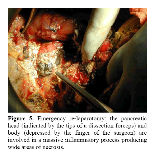 pancreas-massive-inflammatory-process