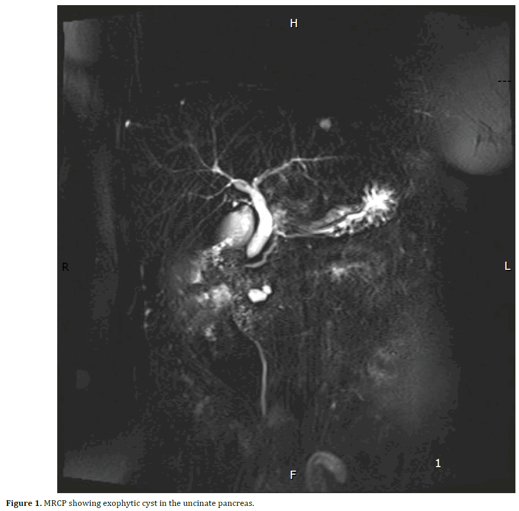 pancreas-mecp-exophytic-cyst