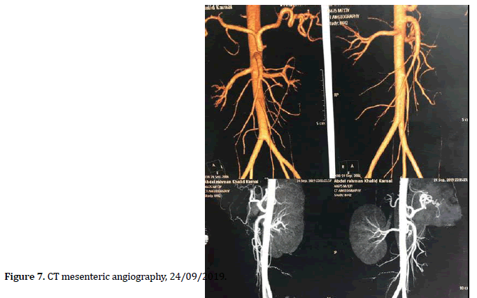 pancreas-mesenteric-angiography