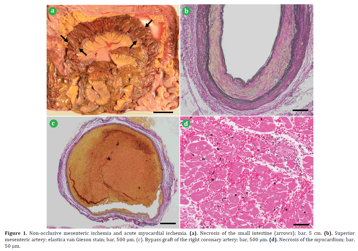 pancreas-mesenteric-ischemia-myocardial
