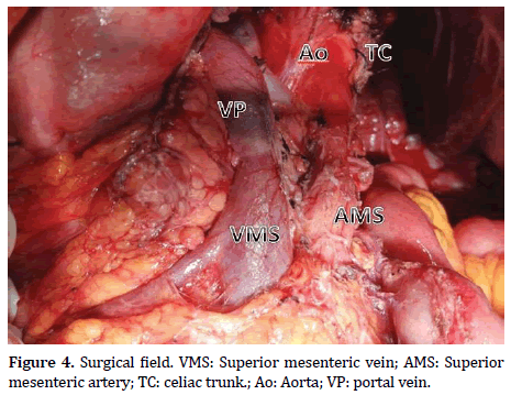 pancreas-mesenteric-vein
