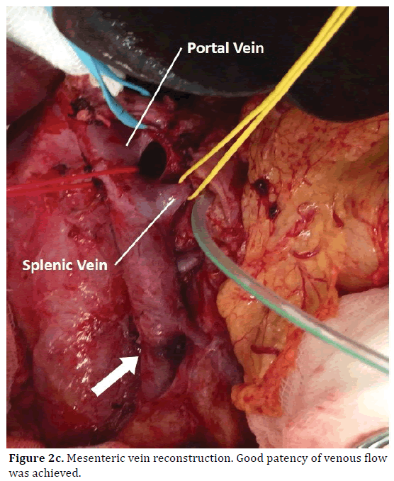 pancreas-mesenteric-vein-reconstruction