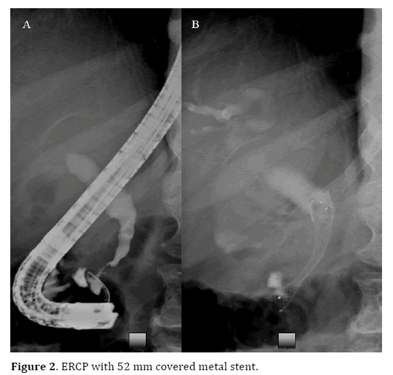 pancreas-metal