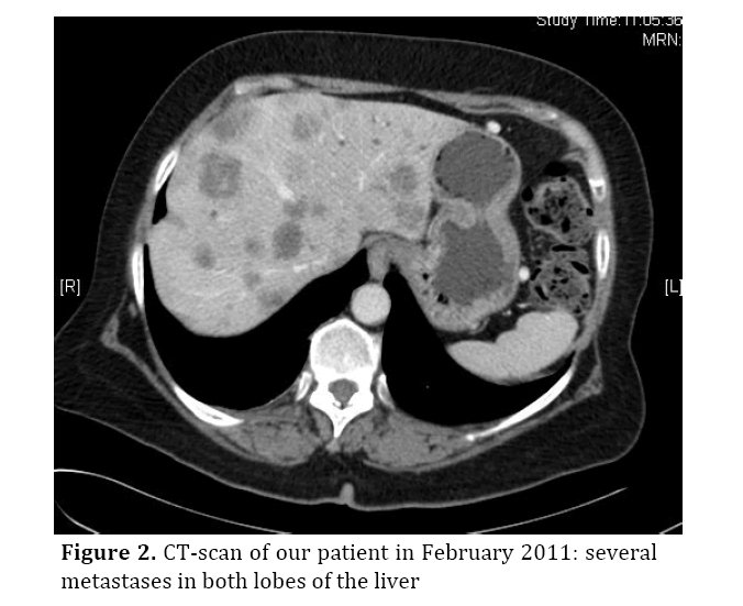 pancreas-metastases-both-lobes