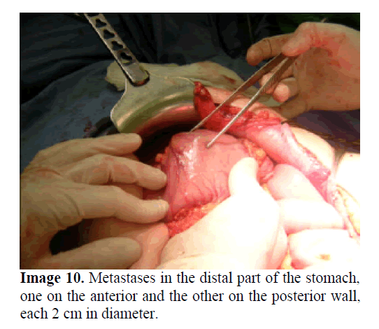 pancreas-metastases-distal-part