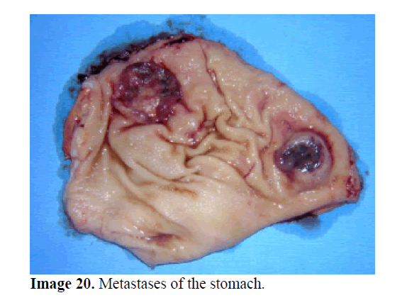pancreas-metastases-stomach