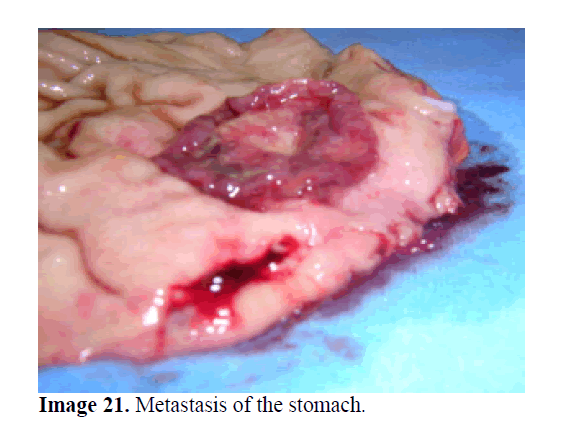 pancreas-metastases-stomach