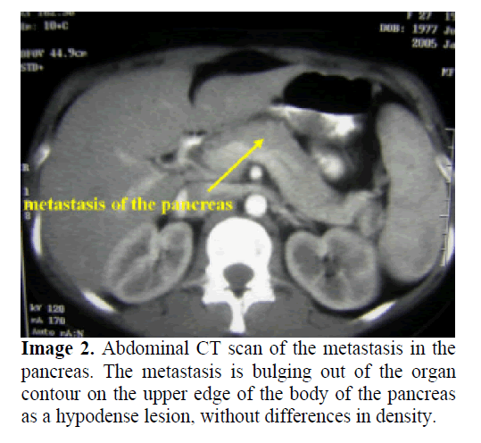 pancreas-metastasis-bulging-out