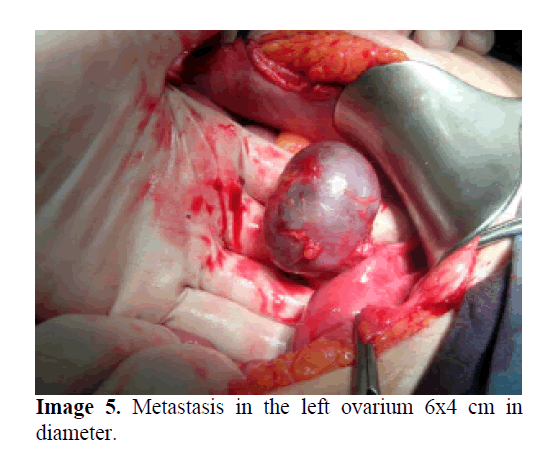 pancreas-metastasis-left-ovarium