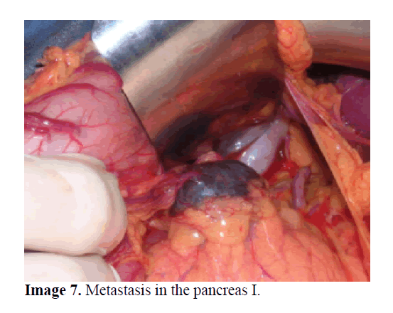 pancreas-metastasis-pancreas-I